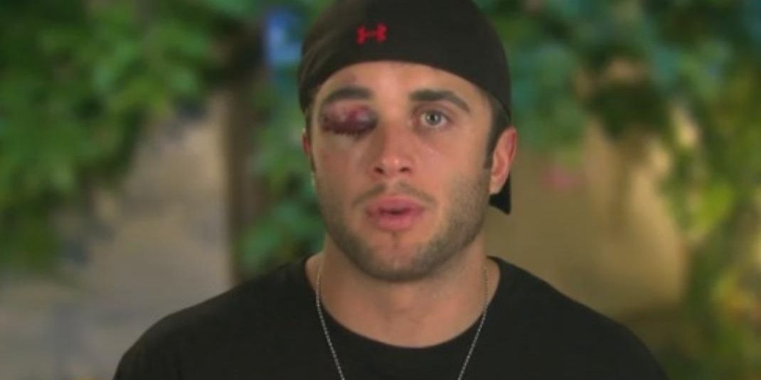 Brad Fiorenza with a black eye on The Ruins