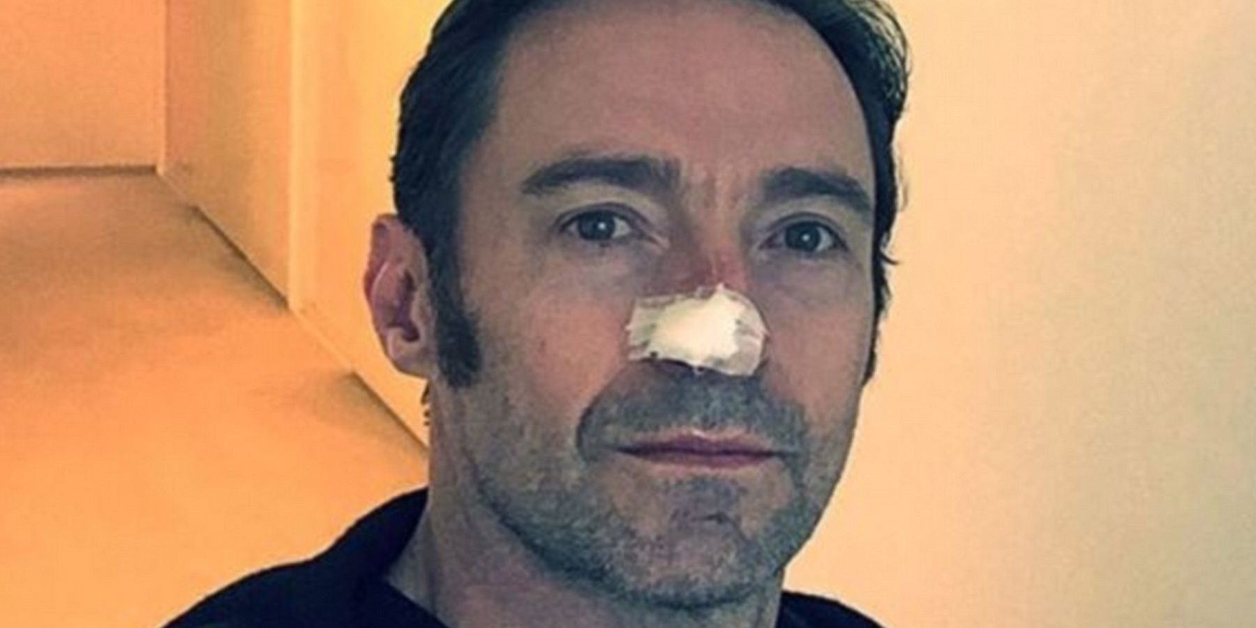 Hugh Jackman with a stitched nose, post-surgery 