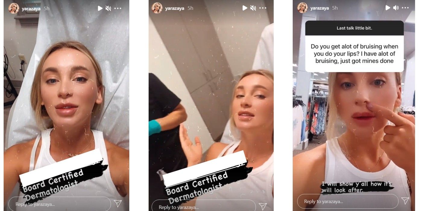 Yara Zaya Lip Filler Plastic Surgery Before After In 90 Day Fiance