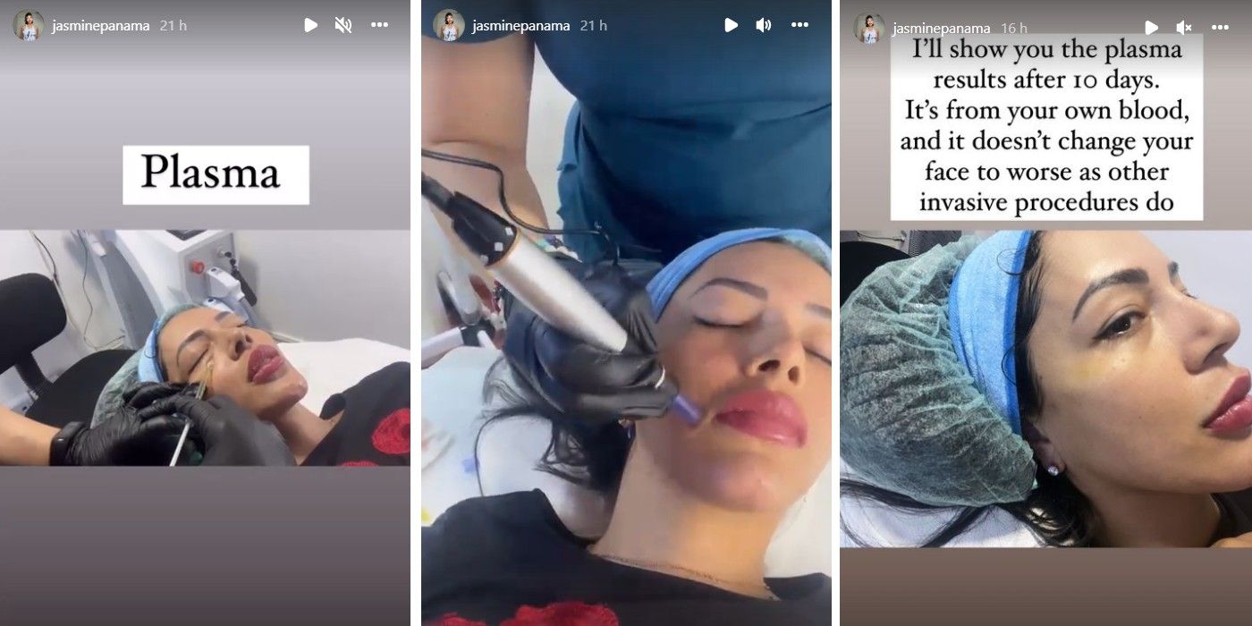 90 Day Fiancé Jasmine Reveals She Underwent Plasma Procedure 