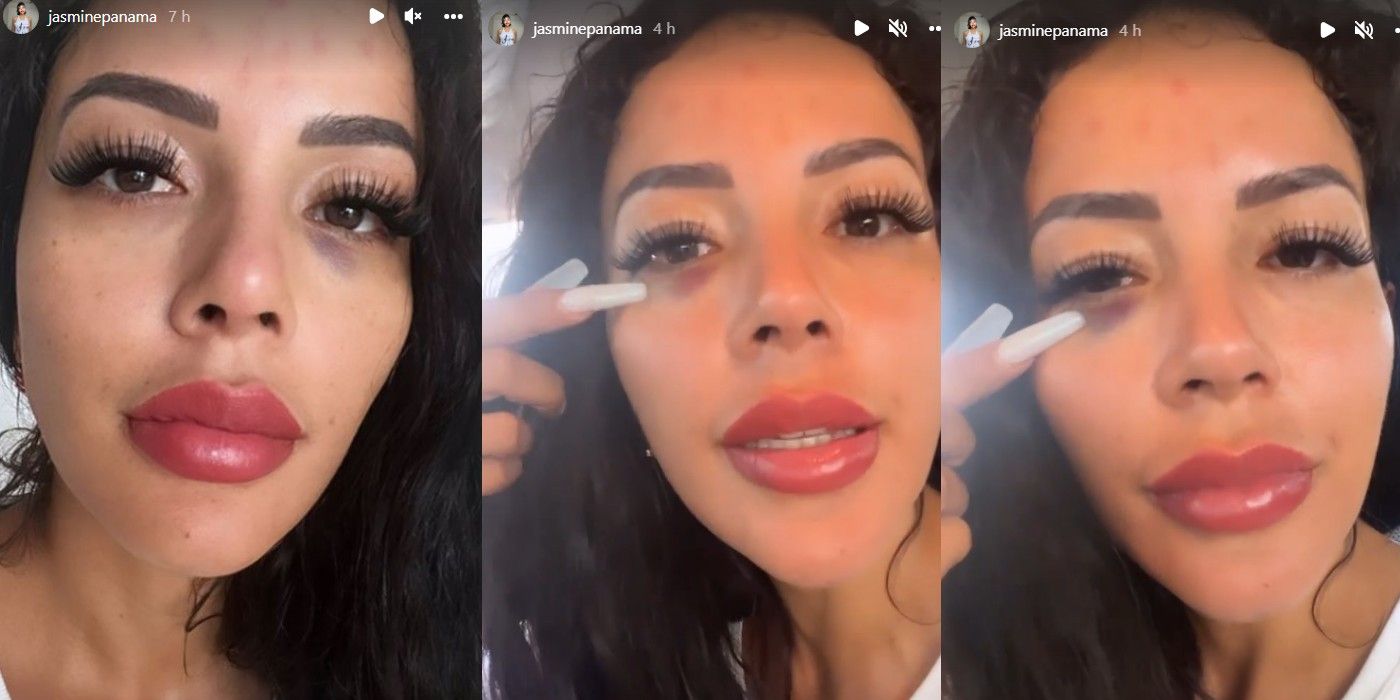 Jasmine Pineda Black Eye Plastic Surgery Instagram In 90 Day Fiance