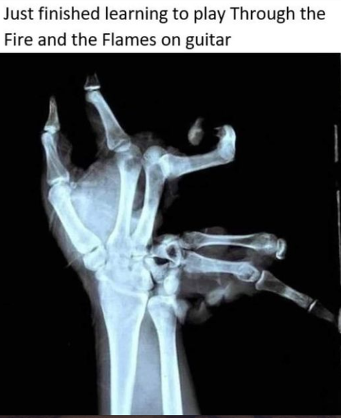 An x-ray of an extremely broken hand with the caption: &quot;Just finished learning to play &quot;Through The Fire And The Flames&quot; on guitar!