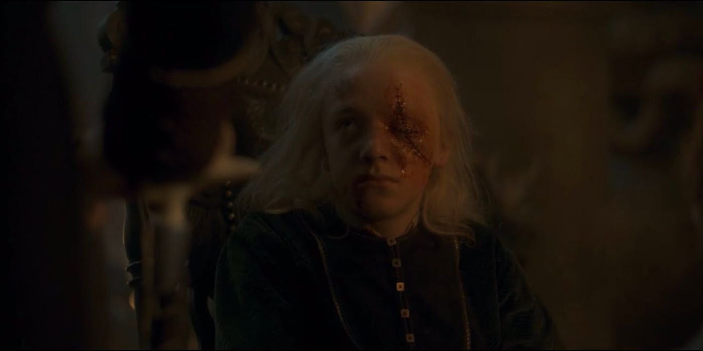 Aemond missing an eye with a stitched face in House of the Dragon. 