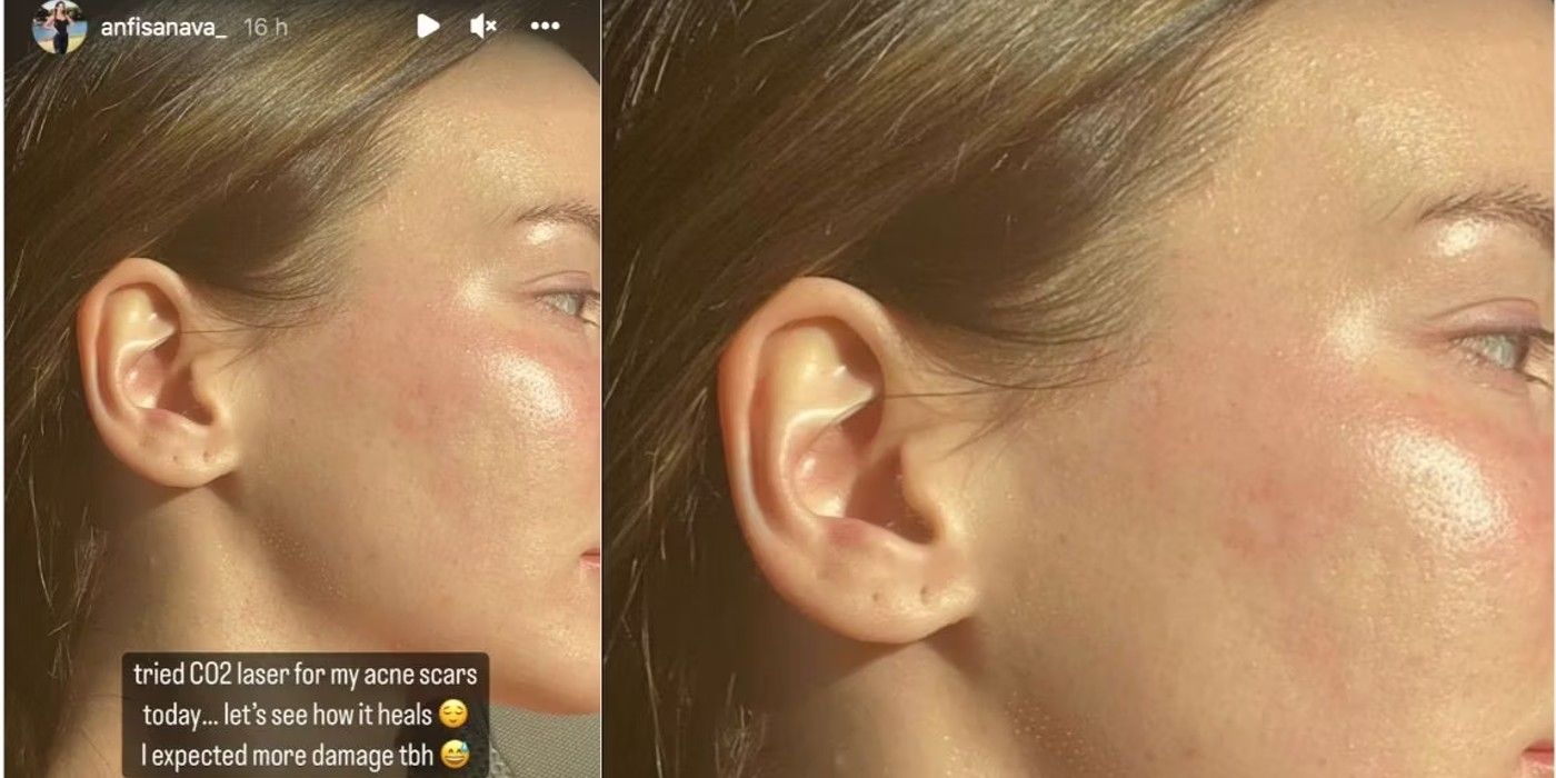 Anfisa Arkhipchenko Remoção de cicatriz de acne 90 dias para noiva