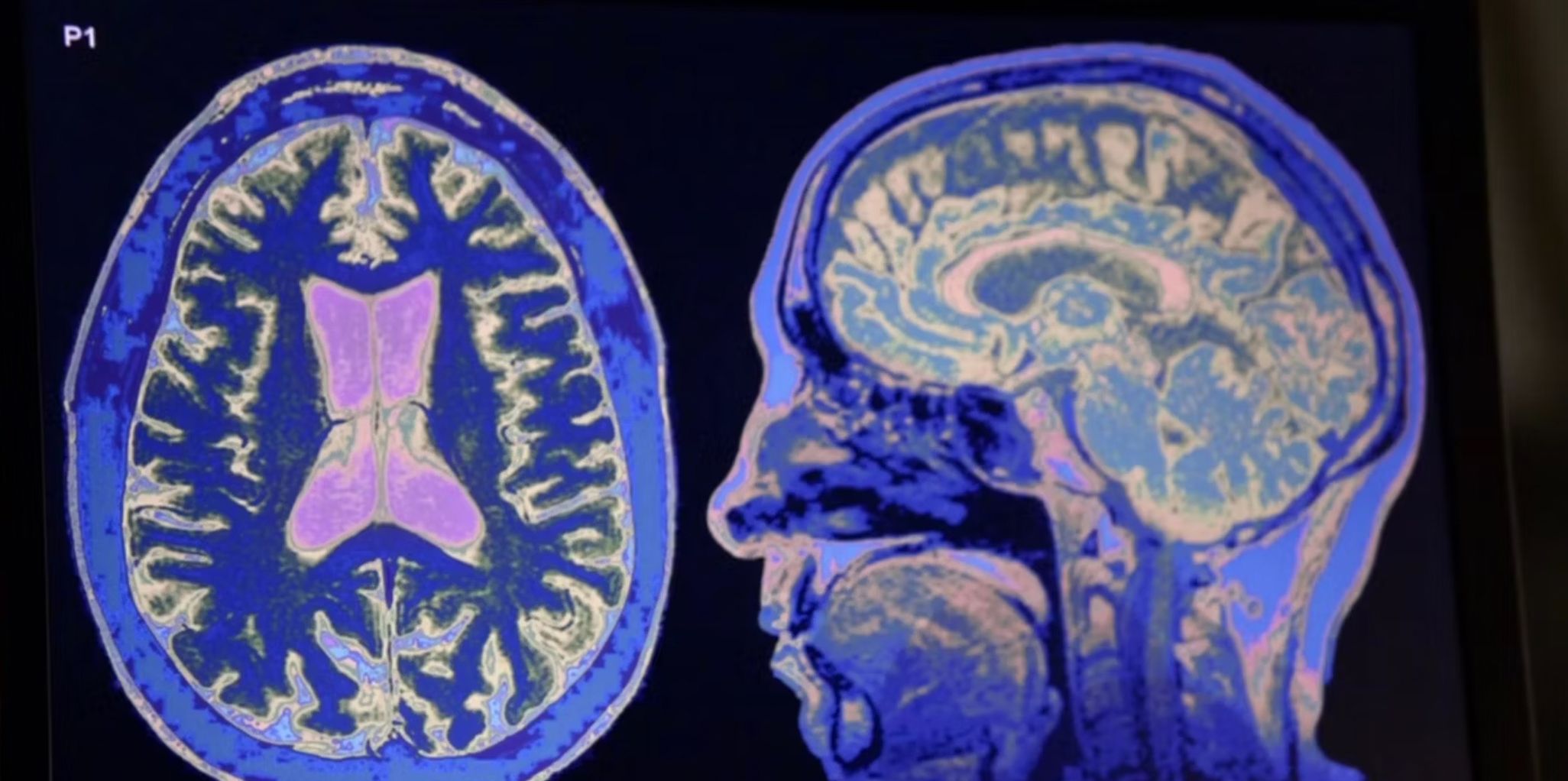 The brain scan belonging to Booth in Bones