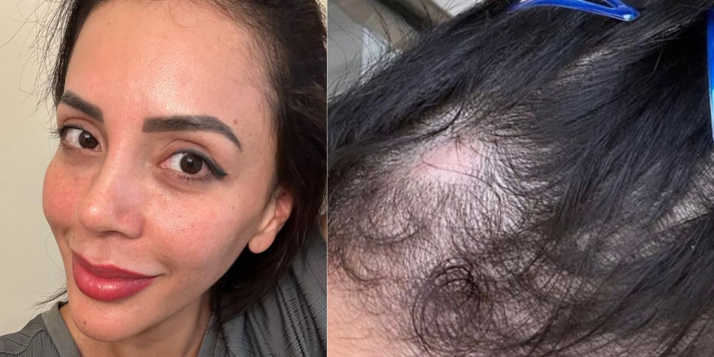 Jasmine from 90 Day Fiance showing the alopecia in her hair