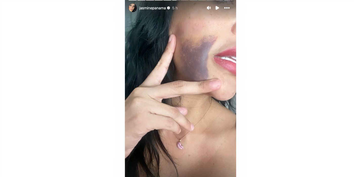 Jasmine Pineda in 90 Day Fiance with face bruise on Instagram